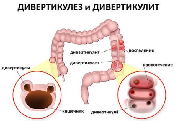 Что такое дивертикулез кишечника?