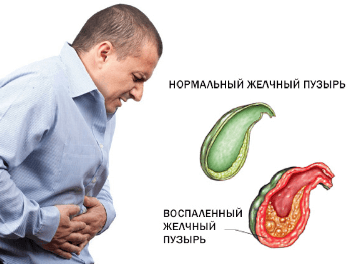 Лечение хронического холецистита в Москве стоимость