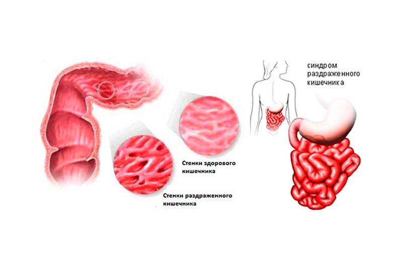 Синдром раздраженного кишечника: причины, симптомы и способы борьбы