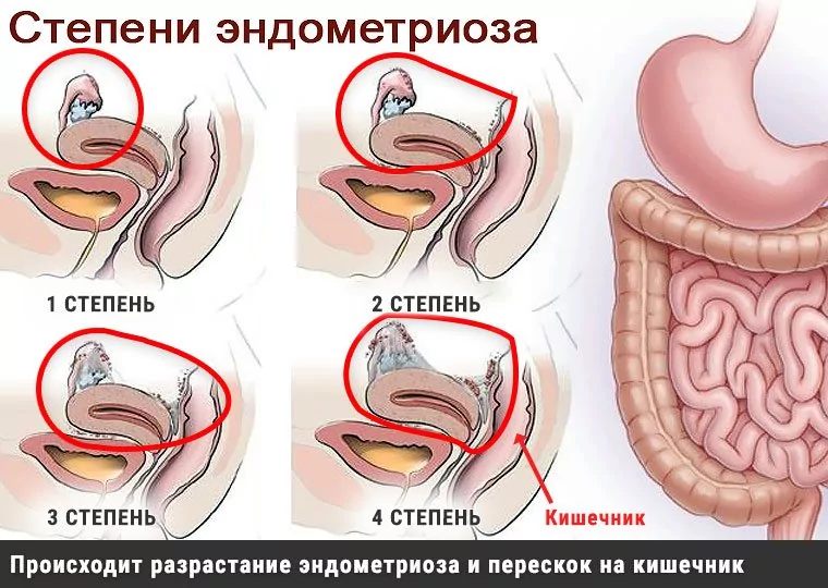 Лечение эндометриоза кишечника в Москве цена «Клиника ABC»
