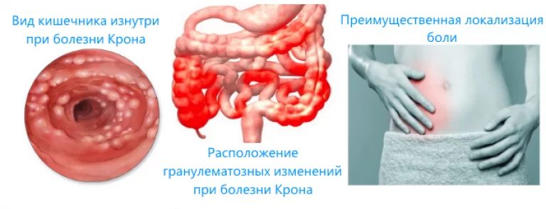 Болезнь крона стол 4